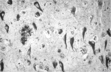 alzheimer-neuroprotection